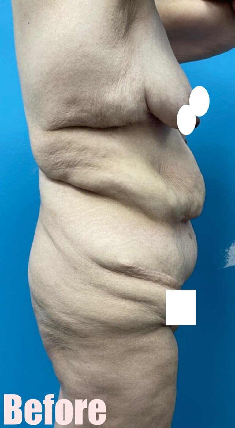 Before Image: Fleur De Lis Abdominoplasty - right-side