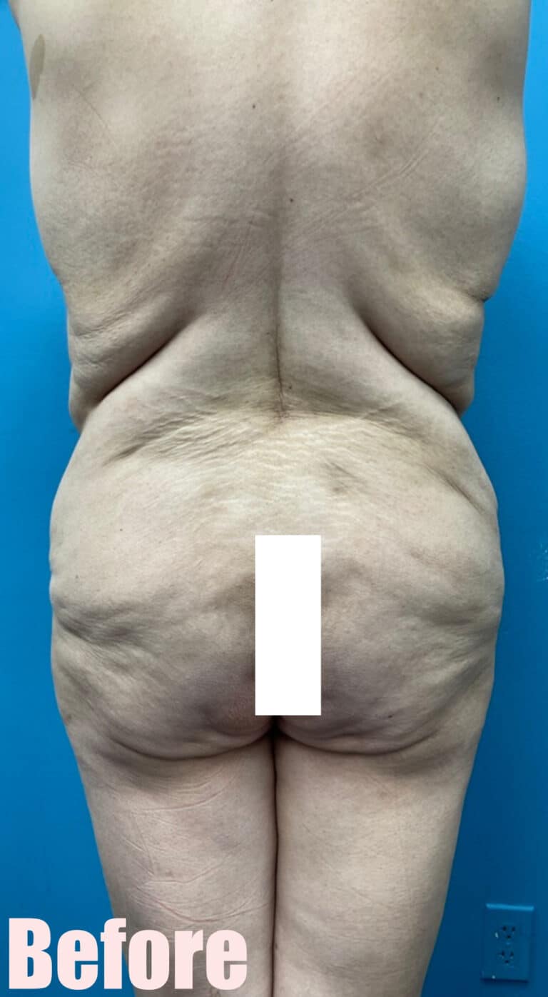 Before Image: Fleur De Lis Abdominoplasty - back