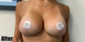 After Image: Secondary Breast Augmentation