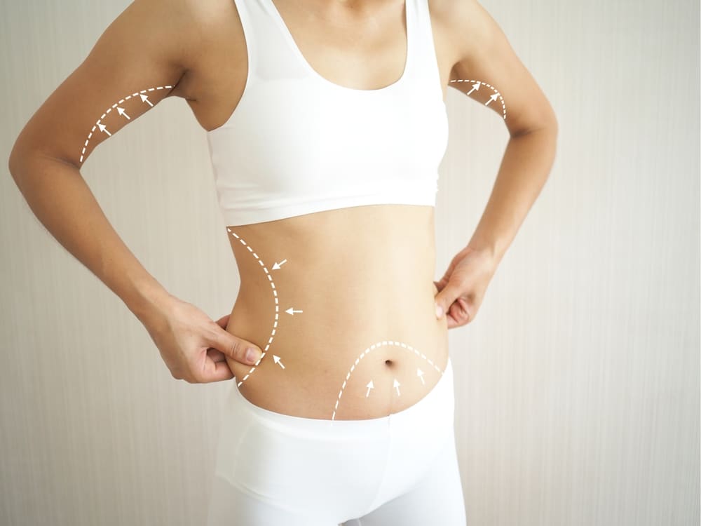 Young woman with white lines superimposed on her body to represent target areas for fat loss during liposuction or tummy tuck