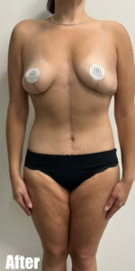 After Image: Circumferential Tummy Tuck with Fleur De lis, BBL and Breast Lift