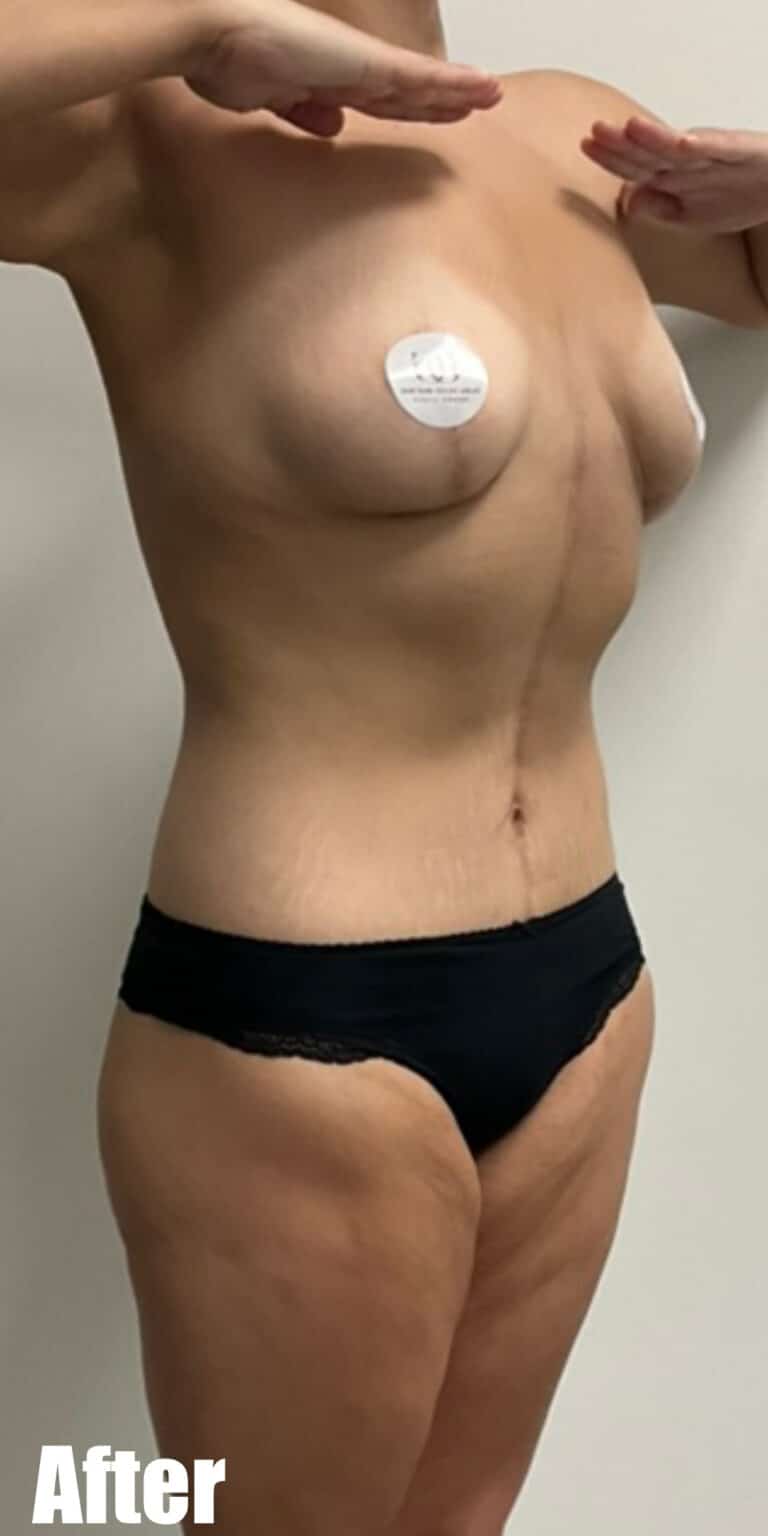 After Image: Circumferential Tummy Tuck with Fleur De lis, BBL and Breast Lift - right-front-oblique