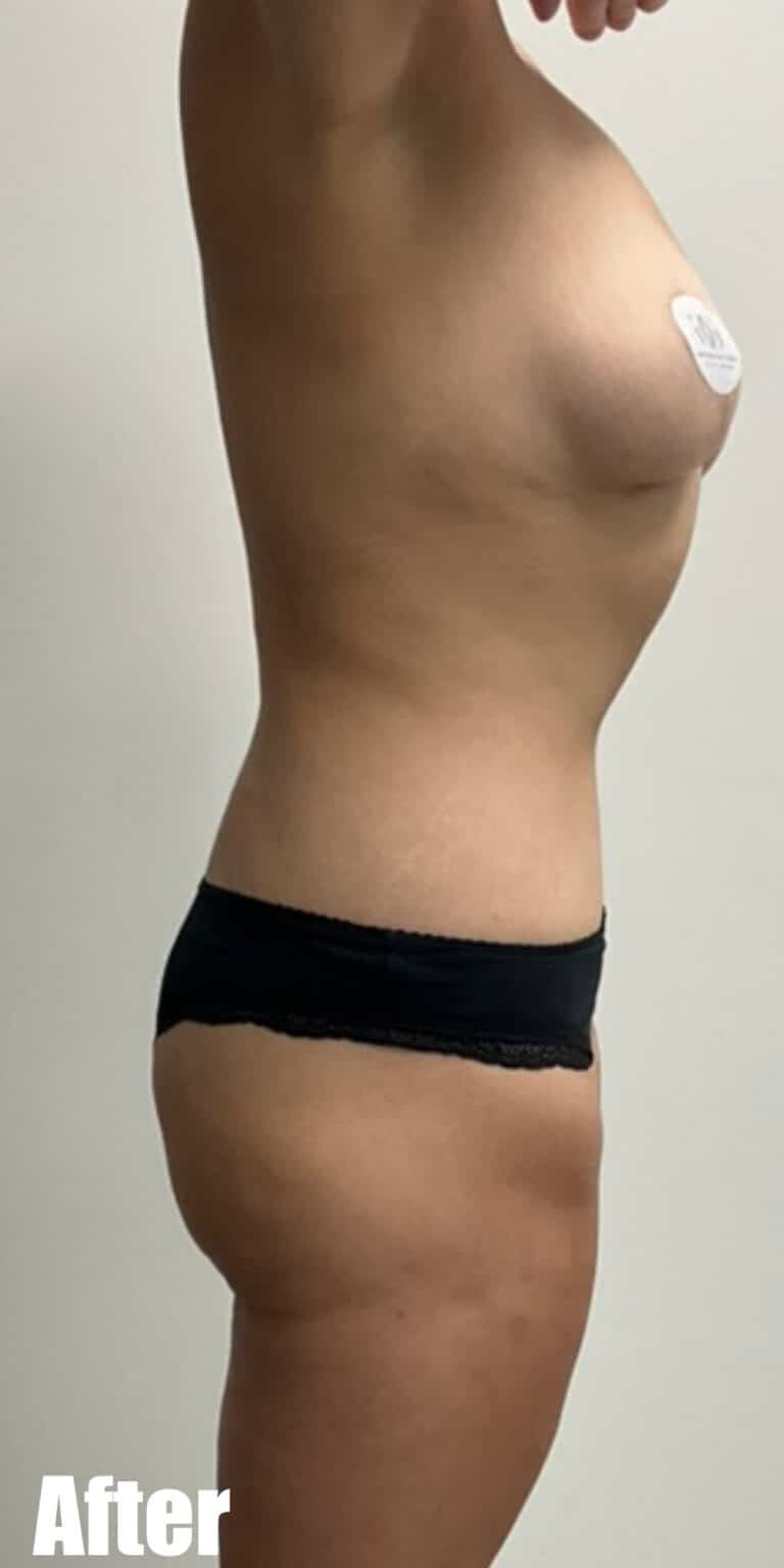 After Image: Circumferential Tummy Tuck with Fleur De lis, BBL and Breast Lift - right-side