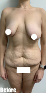 Before Image: Circumferential Tummy Tuck with Fleur De lis, BBL and Breast Lift