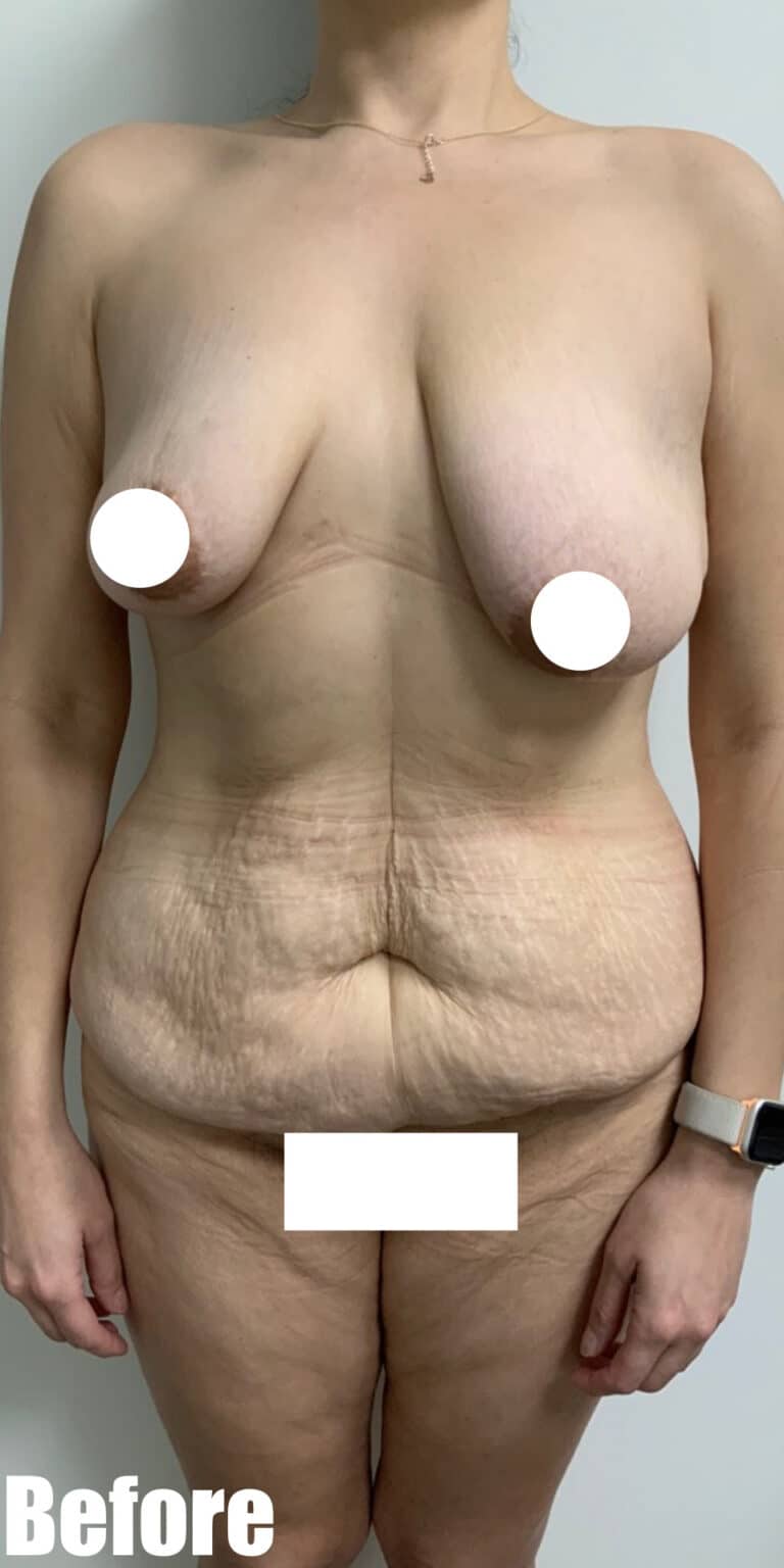 Before Image: Circumferential Tummy Tuck with Fleur De lis, BBL and Breast Lift - front