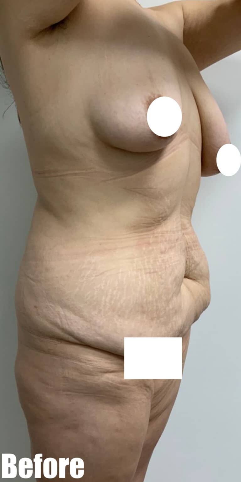 Before Image: Circumferential Tummy Tuck with Fleur De lis, BBL and Breast Lift - right-front-oblique