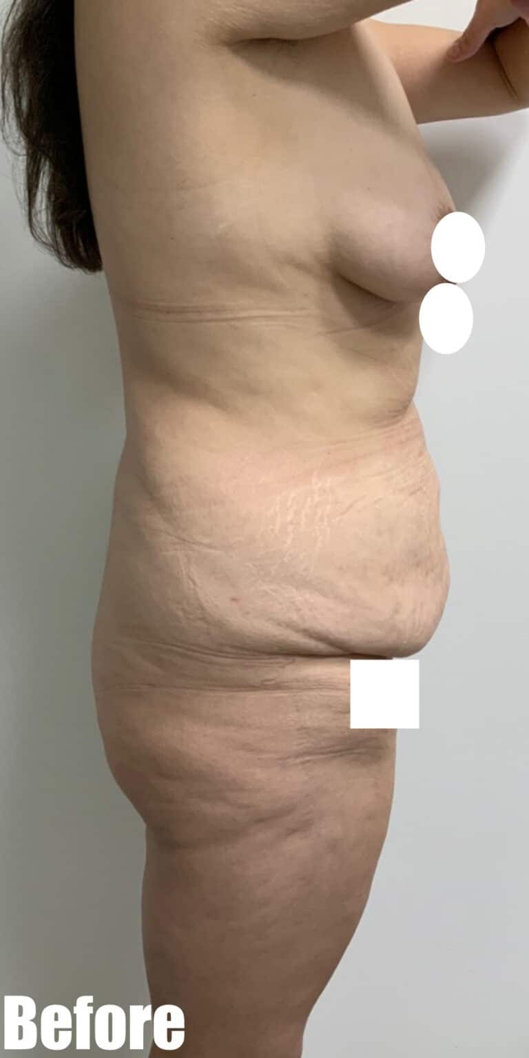 Before Image: Circumferential Tummy Tuck with Fleur De lis, BBL and Breast Lift - right-side