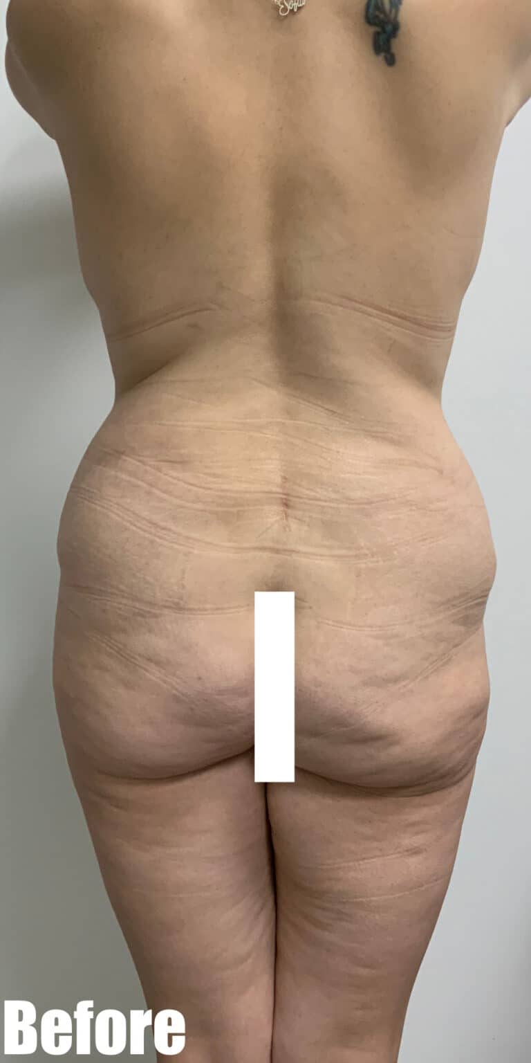 Before Image: Circumferential Tummy Tuck with Fleur De lis, BBL and Breast Lift - back