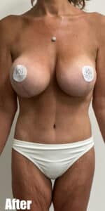 After Image: Circumferential Mamacita Makeover