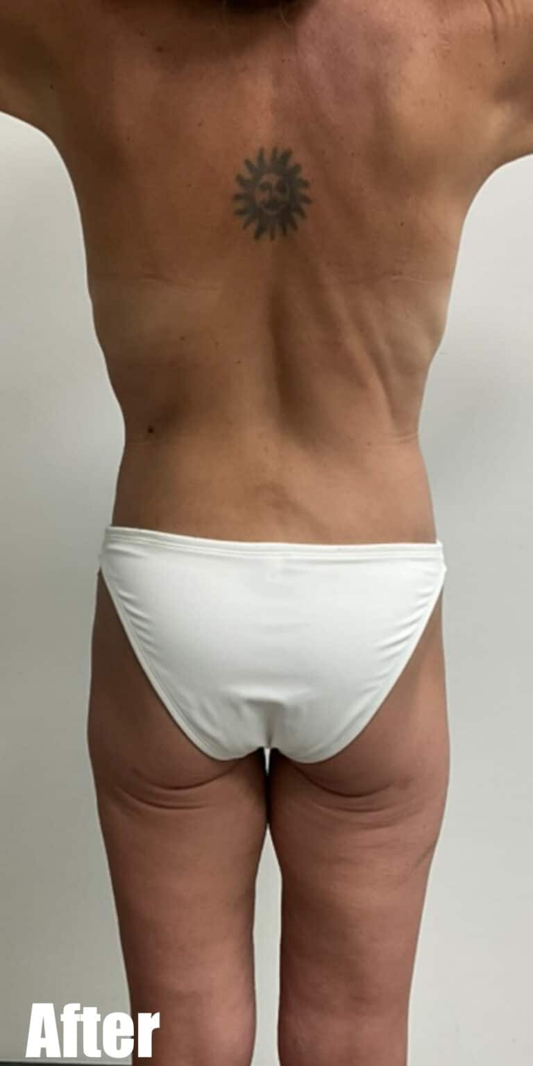 After Image: Circumferential Mamacita Makeover - back