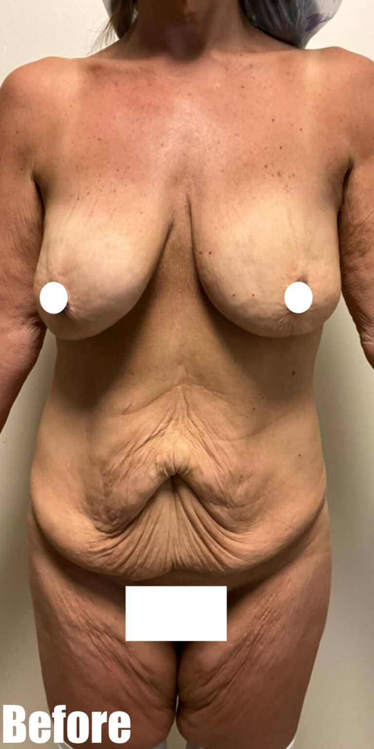 Before Image: Circumferential Mamacita Makeover - front