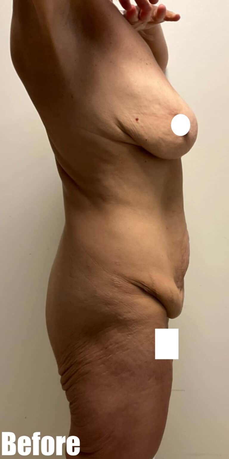 Before Image: Circumferential Mamacita Makeover - right-side