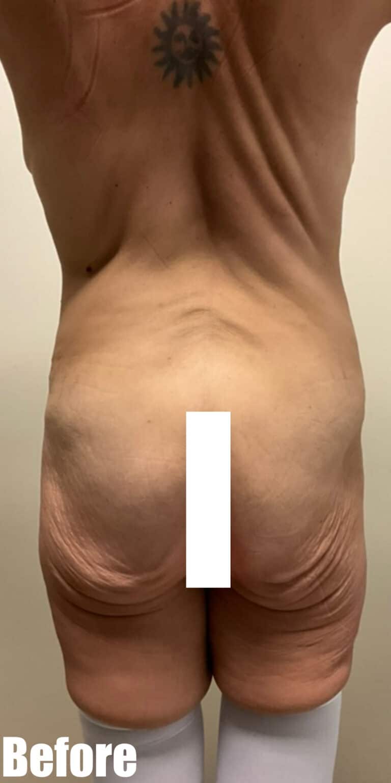 Before Image: Circumferential Mamacita Makeover - back