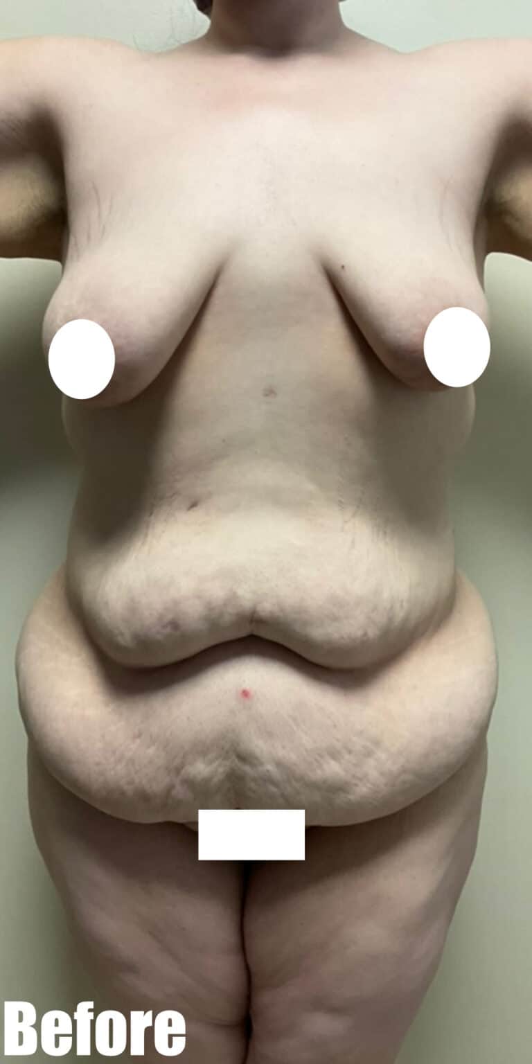 Before Image: Circumferential Fleur De Lis - front