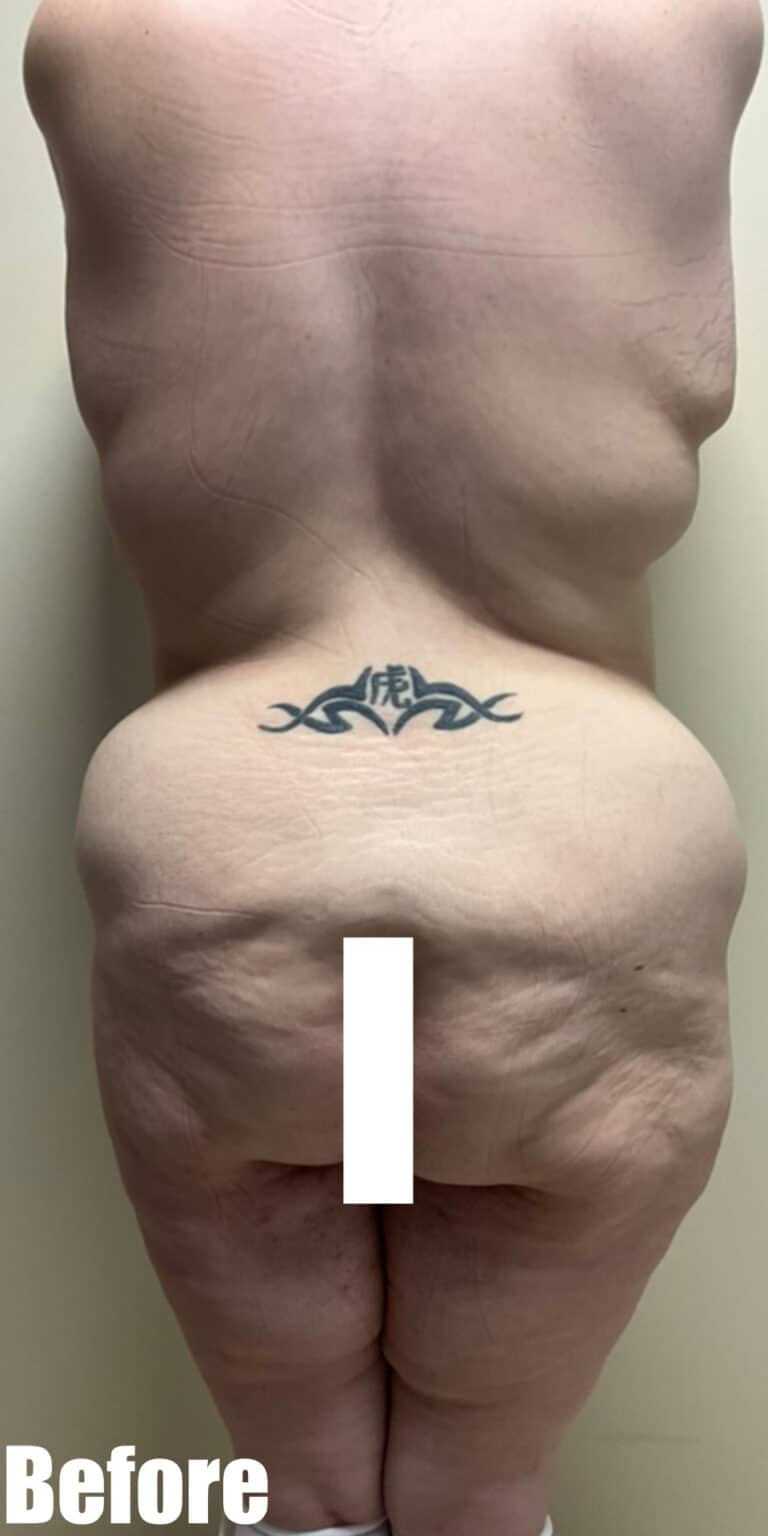 Before Image: Circumferential Fleur De Lis - back
