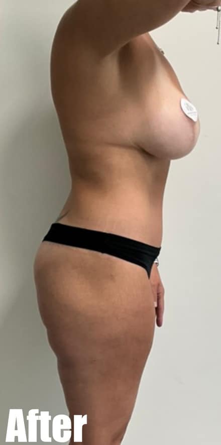 After Image: Circumferential Tummy Tuck with Breast lift and Implant Exchange - right-side