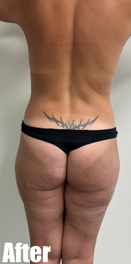 After Image: Circumferential Tummy Tuck with Breast lift and Implant Exchange - back