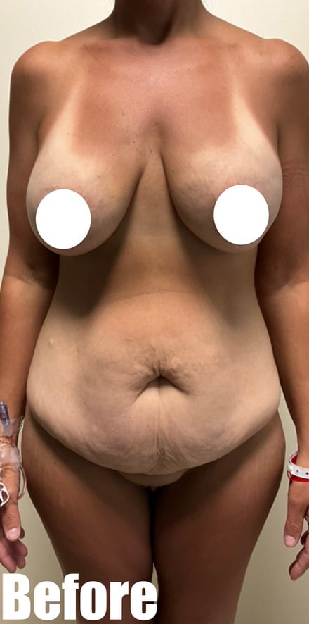 Before Image: Circumferential Tummy Tuck with Breast lift and Implant Exchange - front