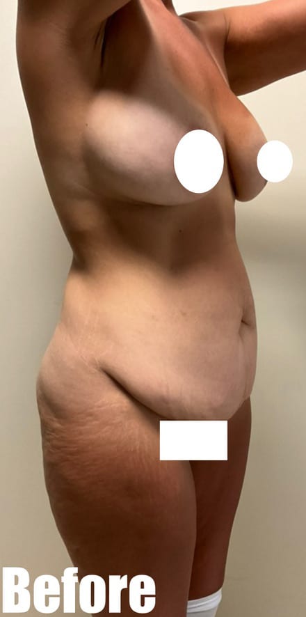 Before Image: Circumferential Tummy Tuck with Breast lift and Implant Exchange - right-front-oblique