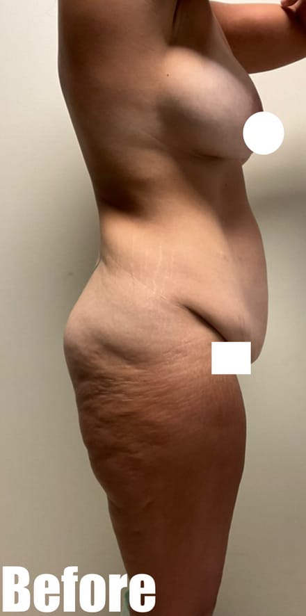Before Image: Circumferential Tummy Tuck with Breast lift and Implant Exchange - right-side