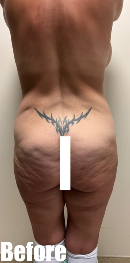Before Image: Circumferential Tummy Tuck with Breast lift and Implant Exchange - back