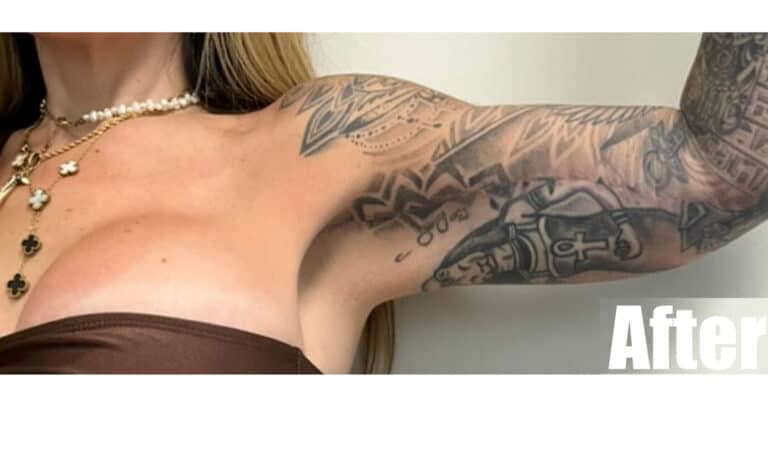 After Image: Arm Lift - front