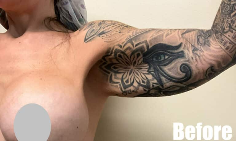 Before Image: Arm Lift - front