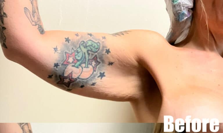 Before Image: Arm Lift - front