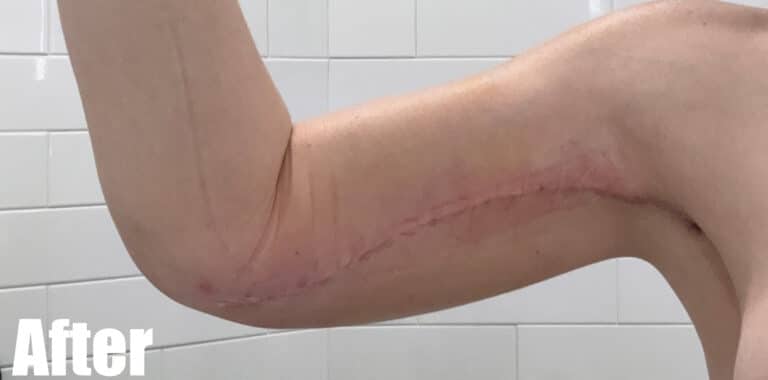 After Image: Arm Lift After Weight Loss - front