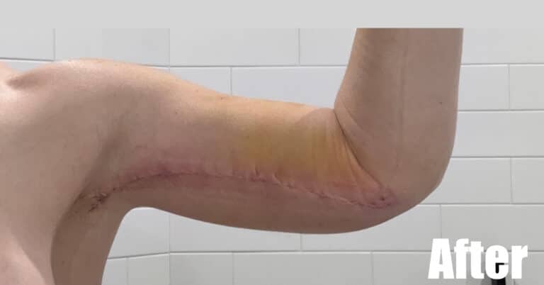 After Image: Arm Lift After Weight Loss - front