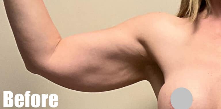 Before Image: Arm Lift After Weight Loss - front