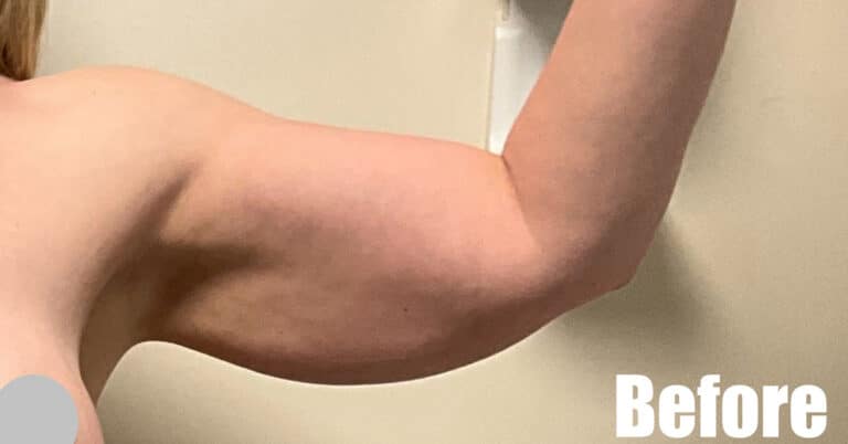 Before Image: Arm Lift After Weight Loss - front