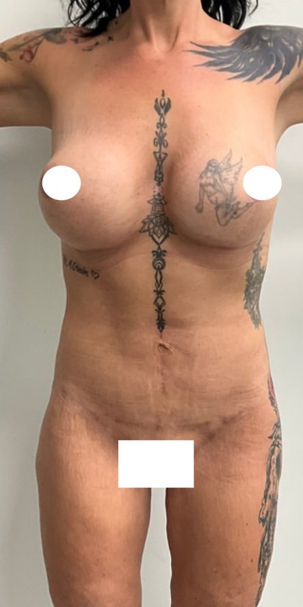 After Image: Fleur De Lis Tummy Tuck - front