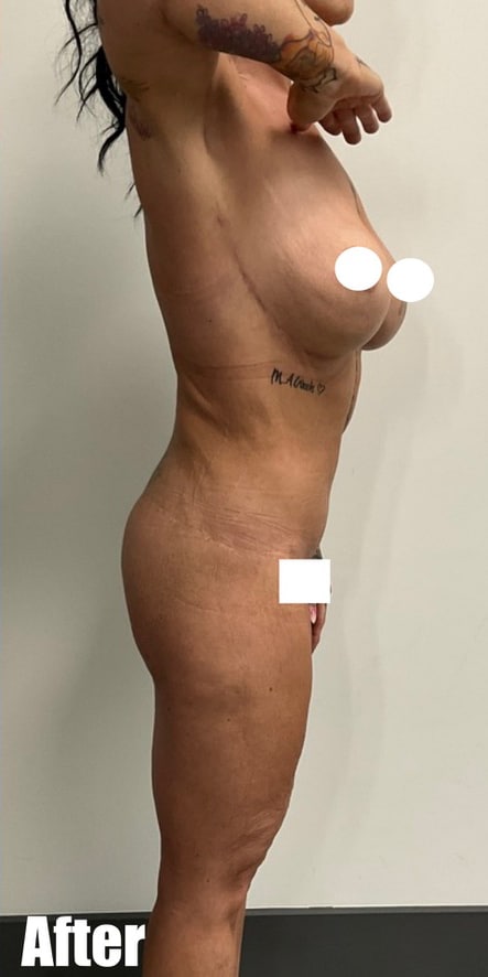 After Image: Fleur De Lis Tummy Tuck - right-side