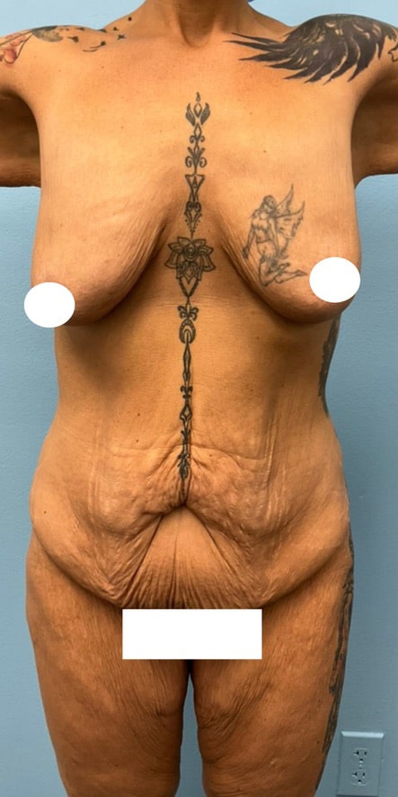 Before Image: Fleur De Lis Tummy Tuck - front