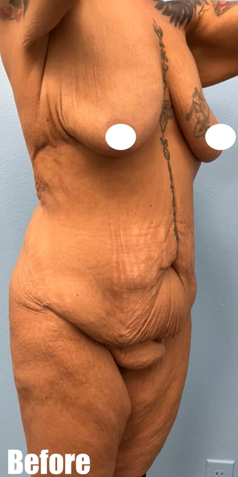 Before Image: Fleur De Lis Tummy Tuck - right-front-oblique