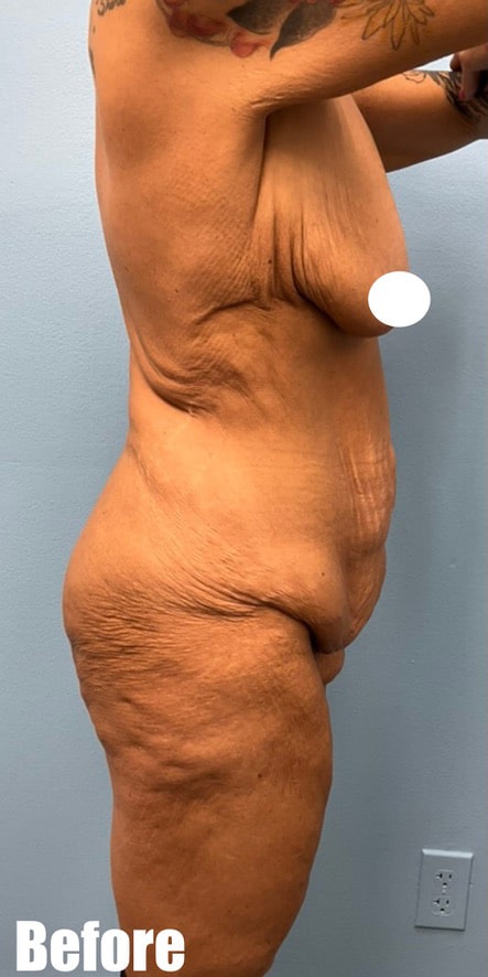 Before Image: Fleur De Lis Tummy Tuck - right-side