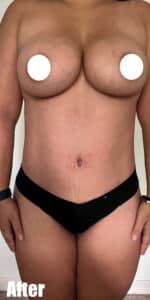 After Image: Mommy Makeover