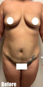 Before Image: Mommy Makeover