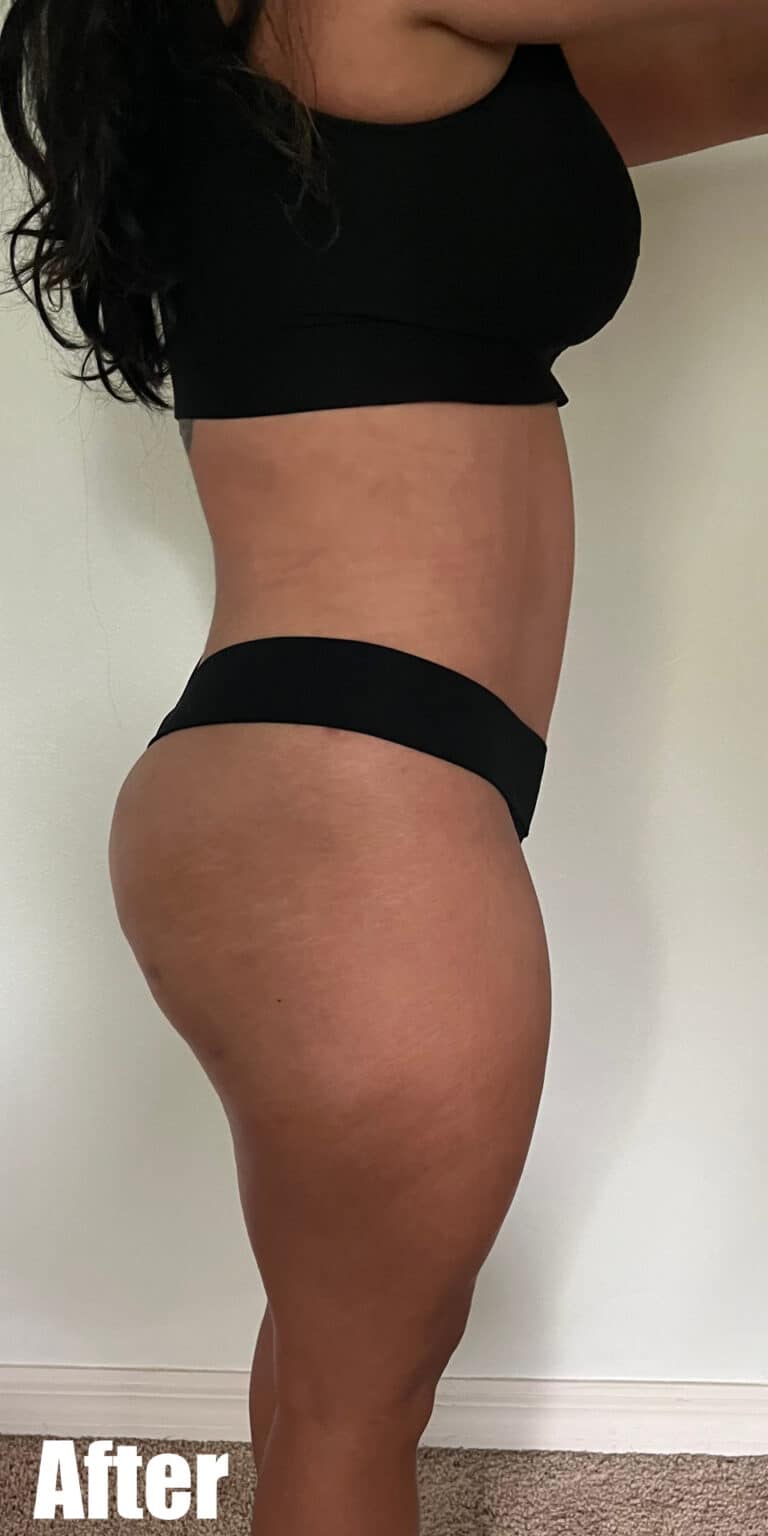 After Image: Mommy Makeover - right-side