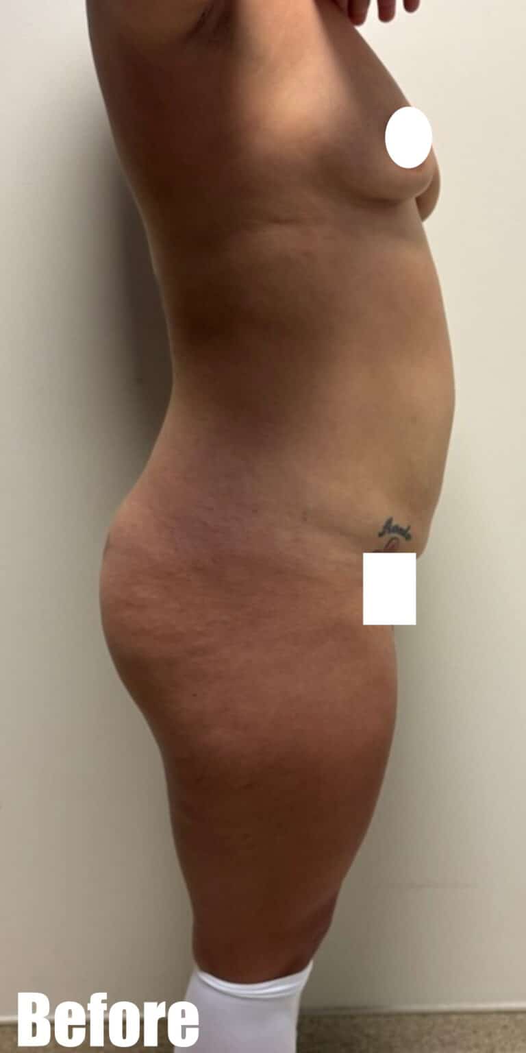 Before Image: Mommy Makeover - right-side