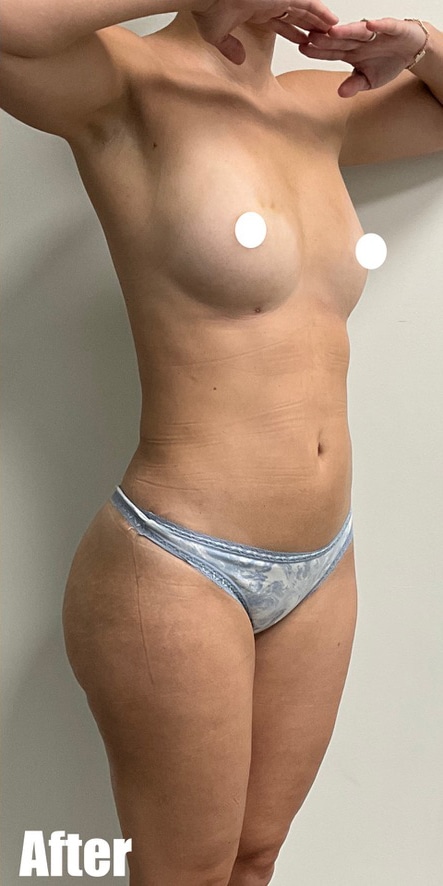 After Image: Brazilian Buttock Lift - right-front-oblique