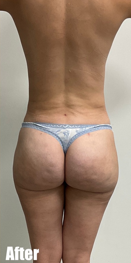 After Image: Brazilian Buttock Lift - back