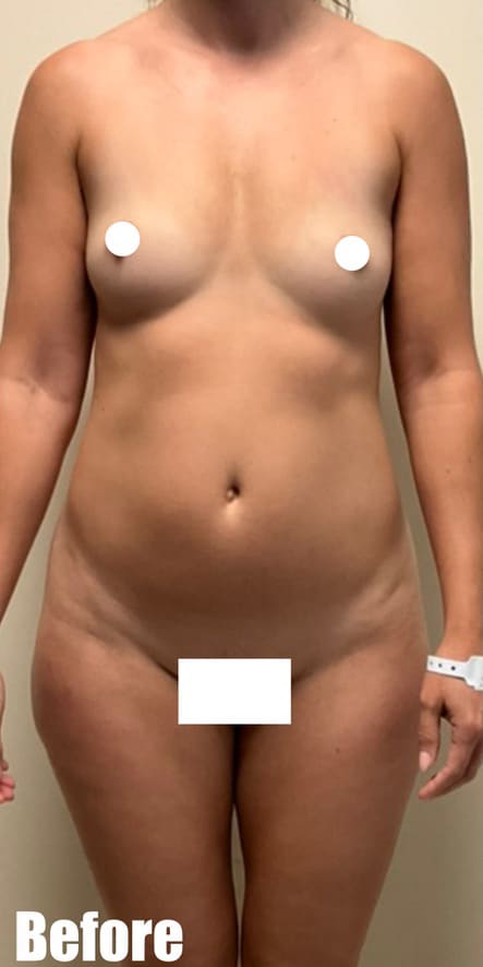 Before Image: Brazilian Buttock Lift - front