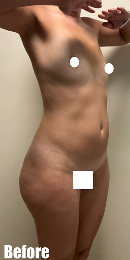 Before Image: Brazilian Buttock Lift - right-front-oblique