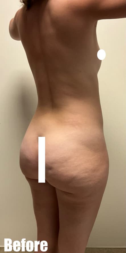 Before Image: Brazilian Buttock Lift - right-back-oblique