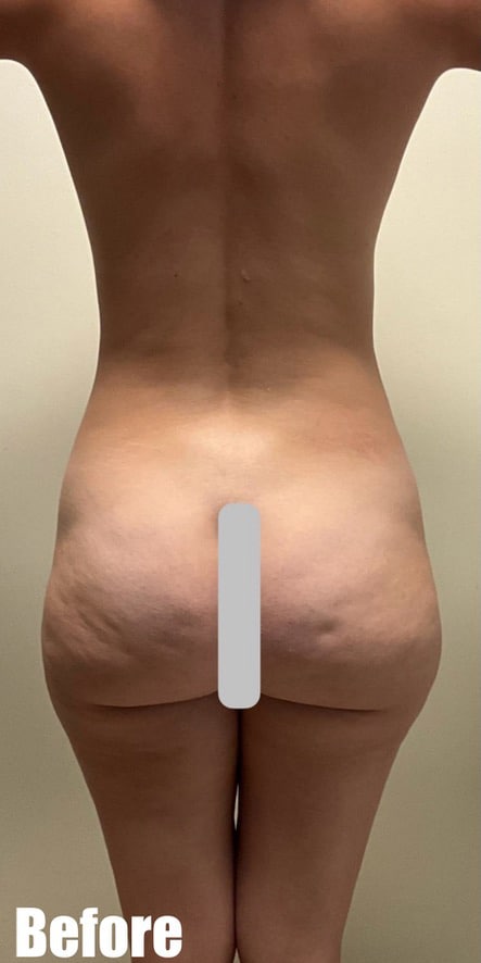 Before Image: Brazilian Buttock Lift - back