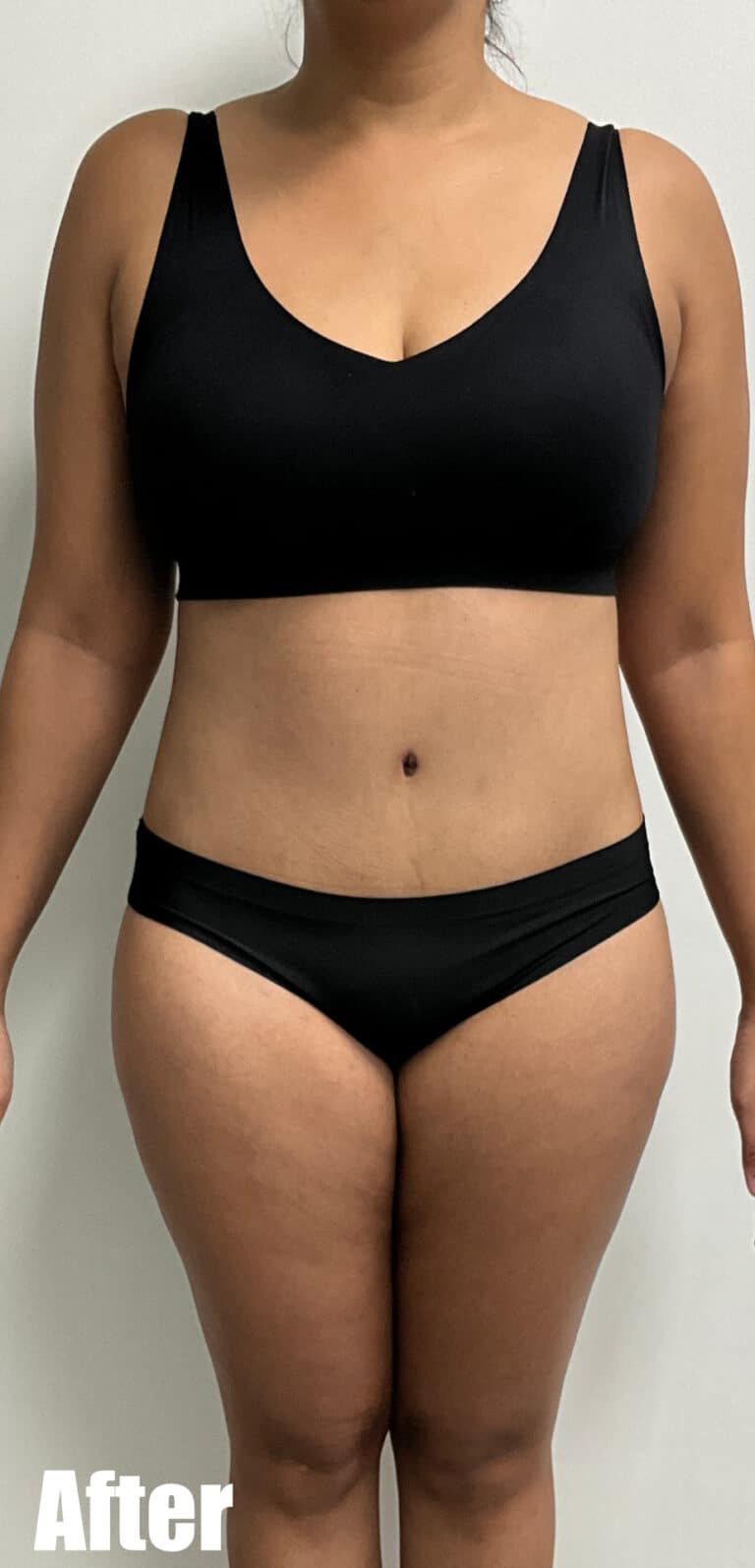 After Image: Circumferential Tummy Tuck - front