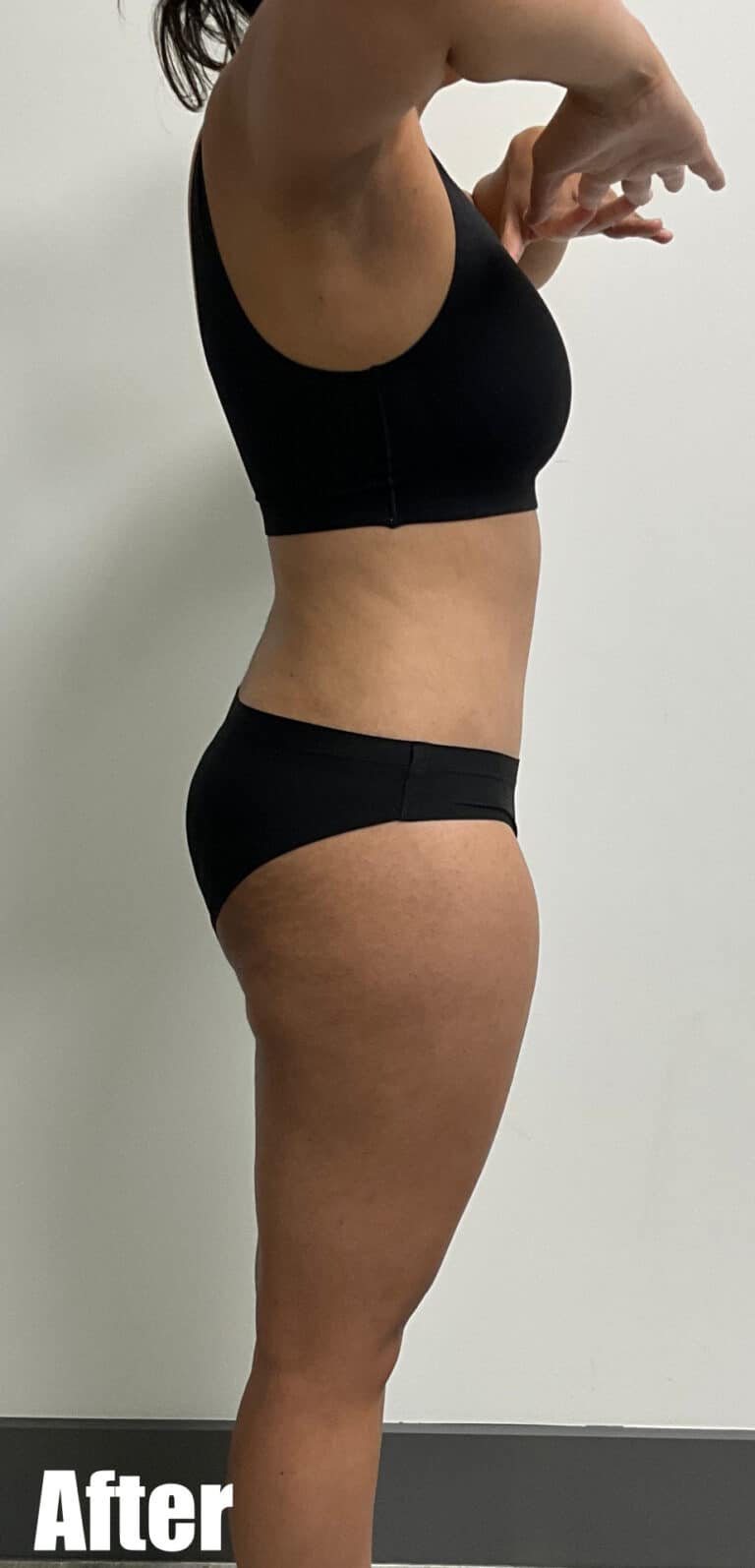 After Image: Circumferential Tummy Tuck - right-side