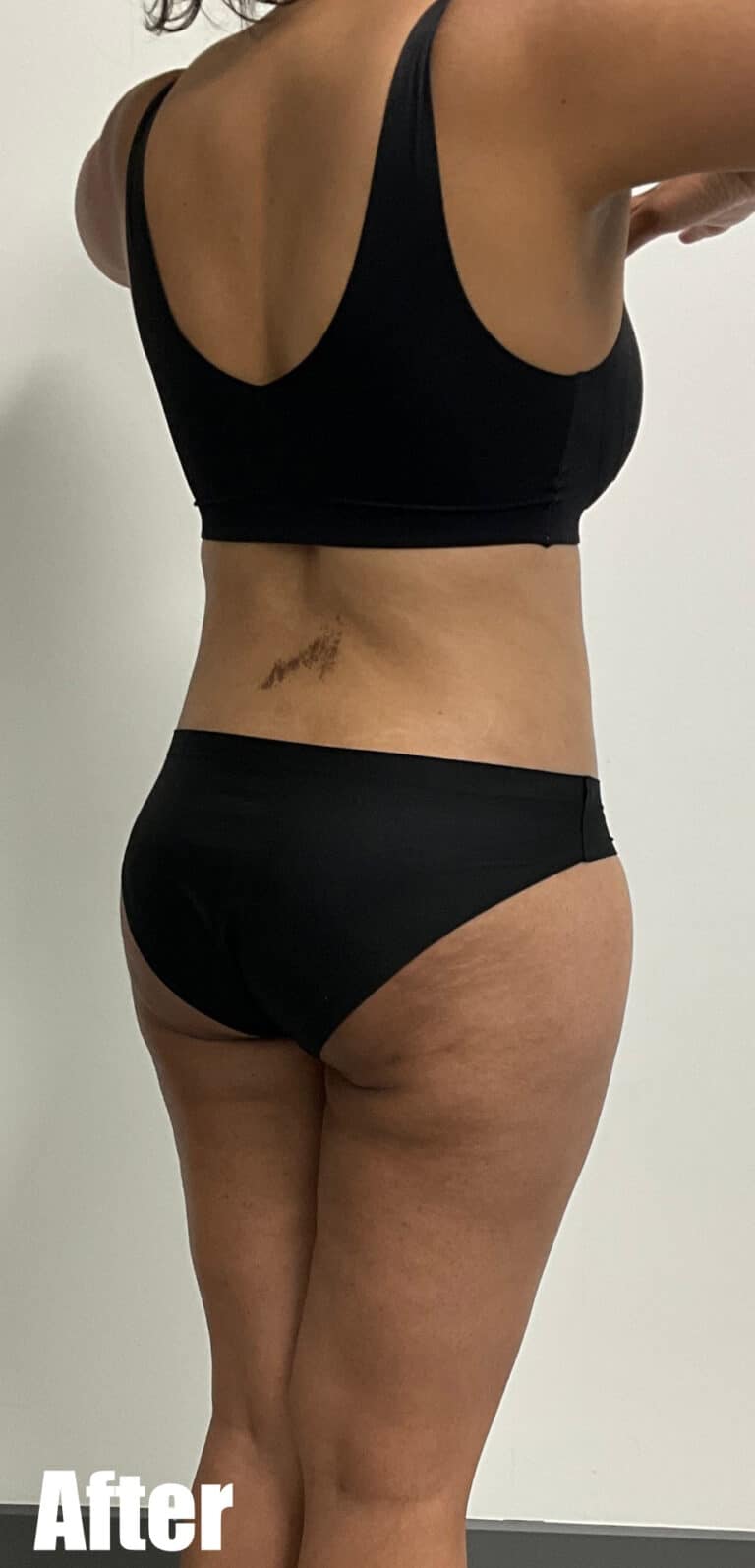 After Image: Circumferential Tummy Tuck - right-back-oblique